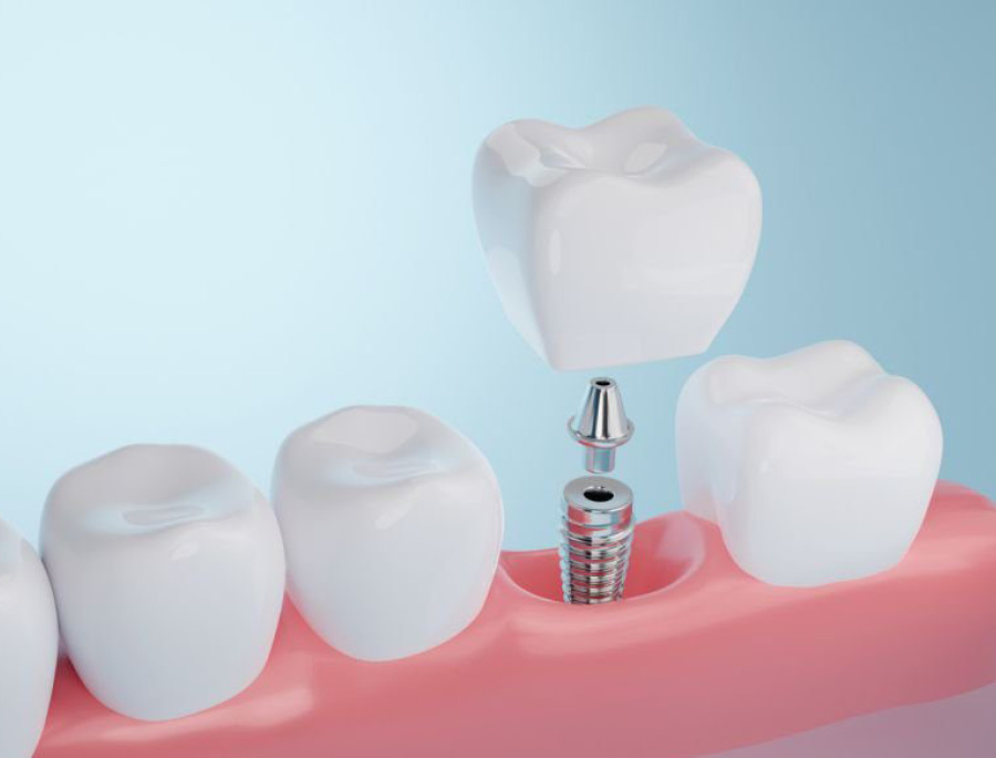 Mini dental implants at London Road Dental Surgery